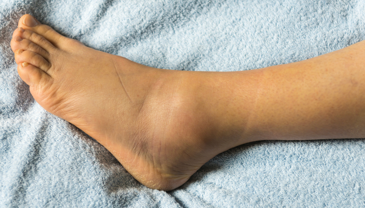 Umgeknickter Knöchel: Symptome, Behandlung und Vorbeugung